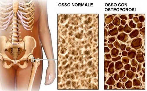 Nguy cơ loãng xương khi sử dụng corticoid