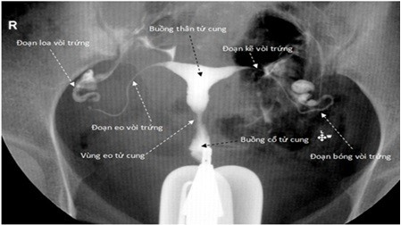  Chụp X-quang tử cung, vòi trứng tìm nguyên nhân hiếm muộn ở nữ
