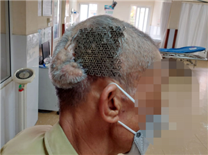 Người đàn ông nhập viện với tấm Titatium hở trên sọ não