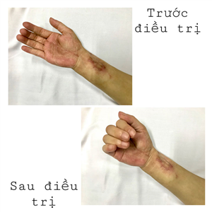 Hiệu quả điều trị phục hồi chức năng cho người bệnh hạn chế vận động cổ bàn tay sau phẫu thuật