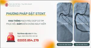 Đặt stent động mạch vành - Quyết định cấp bách trong nhồi máu cơ tim cấp