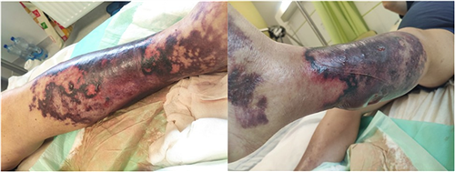 Vi khuẩn ăn thịt người (Vibrio Vulnificus) - Mối nguy hiểm tiềm ẩn không thể bỏ qua