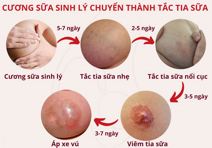 CƯƠNG SỮA SINH LÝ LÀ HIỆN TƯỢNG PHỔ BIẾN Ở MẸ SAU SINH GÂY CĂNG TỨC NGỰC
