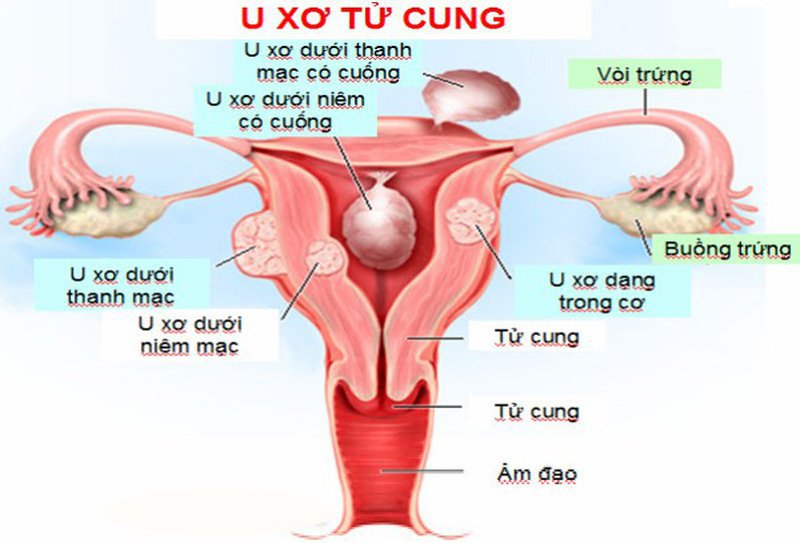 Bệnh Nhân Xơ Tử Cung: Triệu Chứng, Nguyên Nhân và Phương Pháp Điều Trị Hiệu Quả