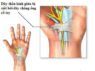 Xoa bóp chữa hội chứng ống cổ tay