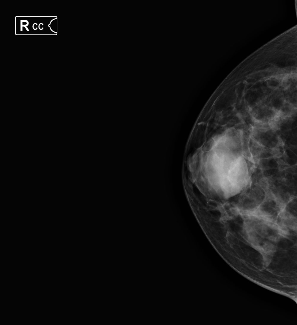 Chụp ảnh nhũ ung thư vú là một phương pháp quan trọng để phát hiện bệnh sớm. Hãy xem qua hình ảnh liên quan để hiểu rõ hơn về quá trình chụp ảnh và cách xử lý kết quả. Việc phát hiện sớm sẽ giúp cho bạn có cơ hội chữa trị bệnh tốt hơn.