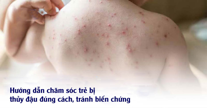 Phòng ngừa thủy đậu cho phụ nữ mang thai và trẻ sơ sinh