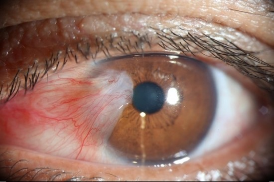 Thuốc nhỏ mắt bôi trơn hoạt động như thế nào trong việc điều trị mộng mắt?
