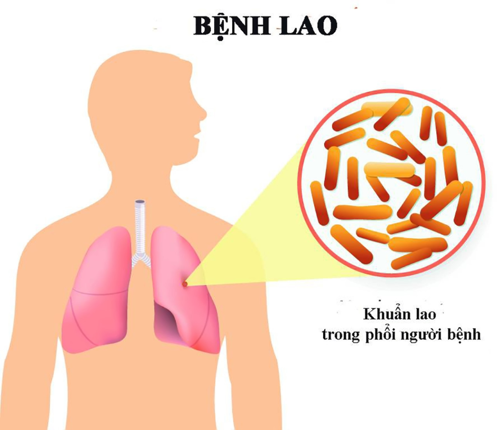 Vi khuẩn nào gây bệnh lao phổi?
