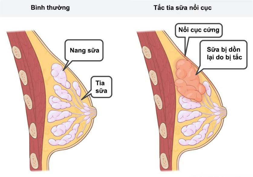 Hiện Tượng Vỡ Nang Sữa: Nguyên Nhân, Triệu Chứng và Cách Phòng Ngừa