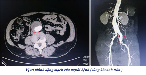 Đặt stent graft –  Giải pháp cứu sống người bệnh phình động mạch chủ