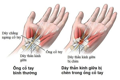 Phục hồi chức năng cho người bệnh mắc hội chứng ống cổ tay