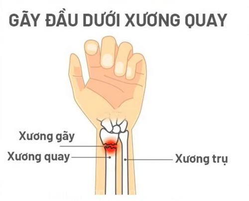 Phục hồi chức năng trong điều trị gãy đầu dưới xương quay