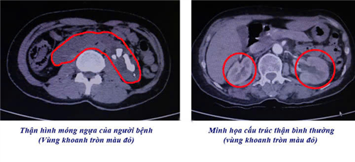 Tán sỏi qua da cho người bệnh dị dạng thận móng ngựa