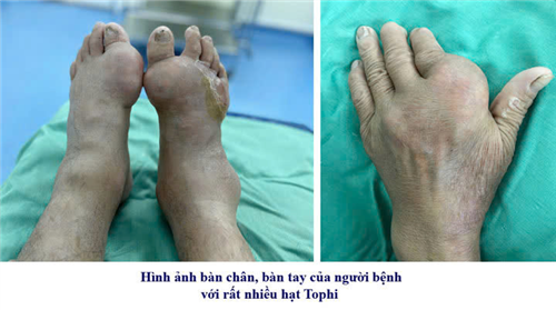 Bệnh gút – Chủ quan có thể gánh hậu quả nặng nề!