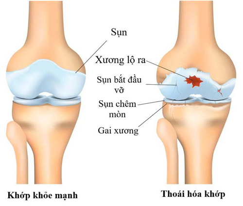 Điều trị thoái hóa khớp bằng phương pháp Y học Cổ truyền