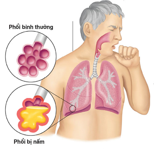U nấm phổi có thể điều trị được không? 
