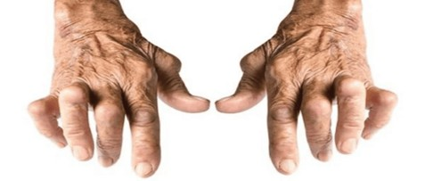 Anti-CCP trong chẩn đoán viêm khớp dạng thấp