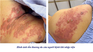 Zona thần kinh không chỉ là bệnh ngoài da mà có thể biến chứng viêm màng não