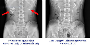 Điều trị thành công sỏi thận – niệu quản phức tạp gây biến chứng suy thận cấp ở người bệnh 16 tuổi