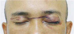 Nguy hiểm: Bị rách mắt vì va phải dây thả diều