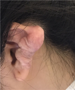 Cẩn trọng biến chứng nguy hiểm khi xỏ khuyên trên vành tai
