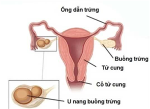 Phẫu thuật nội soi cắt khối u nang buồng trứng xoắn, bảo toàn thai 17 tuần cho sản phụ