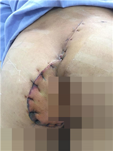 Phẫu thuật cấp cứu cho nam thanh niên bị kính đâm xuyên vùng mông