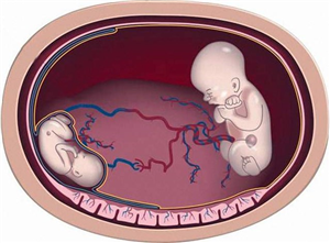 Truyền máu song thai - Bệnh hiếm cần tầm soát khi mang song thai