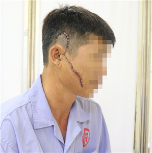 Phẫu thuật cấp cứu cho người bệnh bị khung tôn sắt nặng 50kg rơi vào mặt