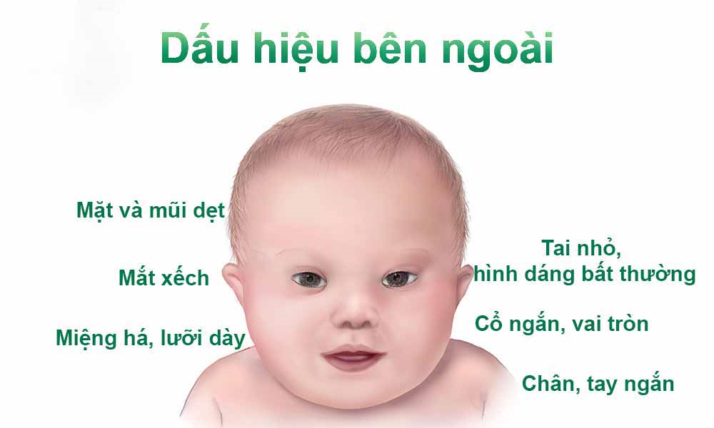 Bí mật bệnh đao xảy ra ở năm hay nữ chưa được khám phá