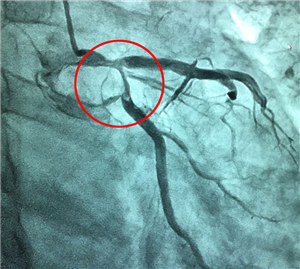 Nhồi máu cơ tim cấp - Biến chứng tắc mạch nghiêm trọng của bệnh lý đa hồng cầu