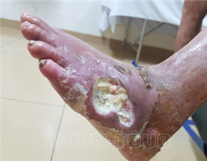 Nhiễm trùng bàn chân trên người bệnh đái tháo đường