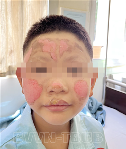 Nghịch bật lửa, trẻ 8 tuổi bị bỏng vùng mặt