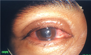 Loét giác mạc sau tai nạn mắt