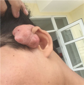 Nam thanh niên nhập viện với sẹo lồi vành tai lớn