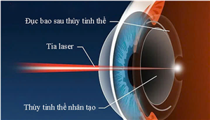 Khôi phục tầm nhìn – Giải pháp từ công nghệ Laser
