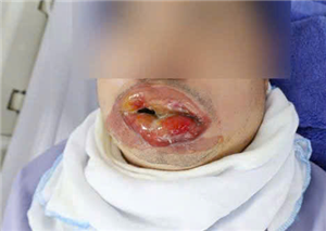 Người đàn ông bị bỏng nặng vùng miệng do xịt khí lạnh chữa bỏng