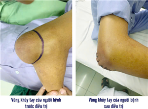 Khối u lớn vùng khuỷu tay do hạt tophy gout
