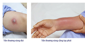 Người phụ nữ bị nhiễm trùng sau khi cấy chỉ tại cơ sở không uy tín