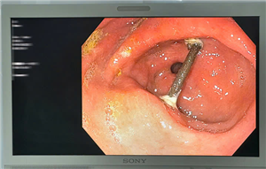 Bị thủng dạ dày do mảnh cành cây