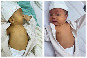 Bất đồng Rh giữa mẹ và thai nhi: Tuyệt đối không chủ quan