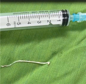 Hiếm gặp: Sán ký sinh trong khối u vùng ổ bụng