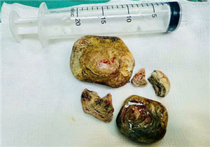 Phẫu thuật thành công lấy khối sỏi bàng quang lớn cho người bệnh