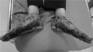 Tự ý ngâm chân bằng nước lá đun nóng, người phụ nữ bị bỏng nặng hai bàn chân