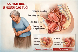 Phẫu thuật sa sinh dục ở người cao tuổi, giúp nâng cao chất lượng cuộc sống