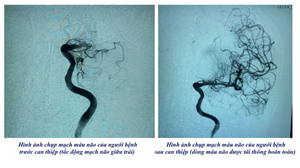 Tiêm tiêu sợi huyết, lấy huyết khối: Chìa khóa vàng cứu sống người bệnh đột quỵ