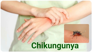 Bệnh Chikungunya: Nguyên nhân, triệu chứng, cách điều trị và phòng bệnh