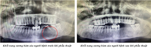 Phục hồi thẩm mỹ cho người bệnh bị khuyết hổng xương do u nang xương hàm