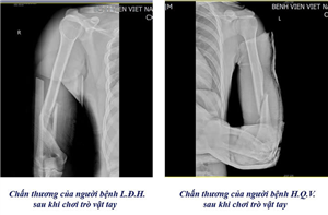 Cảnh báo nguy cơ gãy tay từ trò chơi vật tay